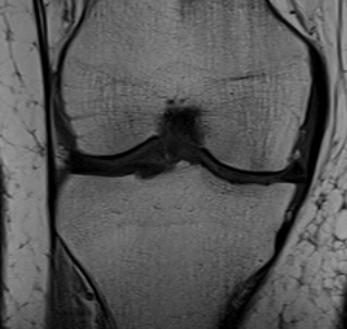 MCL Chronic Femoral Thickening on MRI